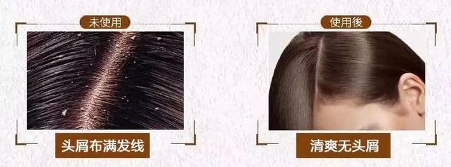 告別脫發(fā)、頭皮屑與頭發(fā)稀少的煩惱，重塑烏黑濃密的秀發(fā)